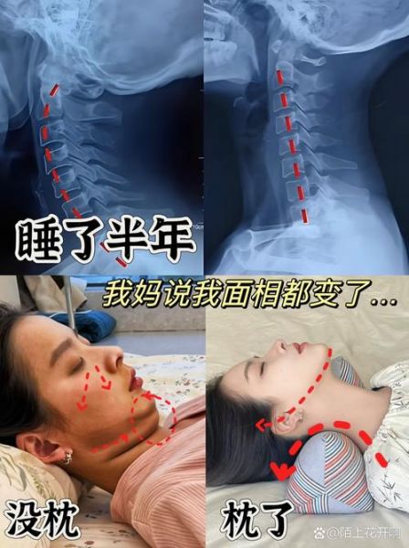 双鱼颈是什么症状_双鱼颈怎么矫正